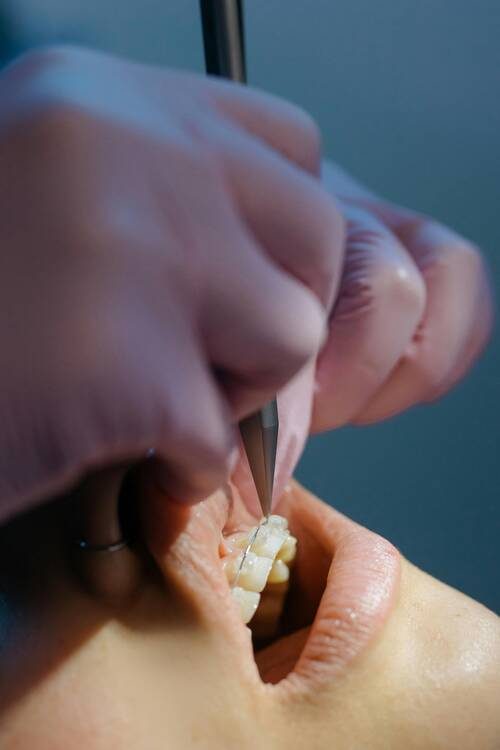 Ceramic invisible braces fitted at REAL PEARL DENTAL CARE, Ahmedabad
