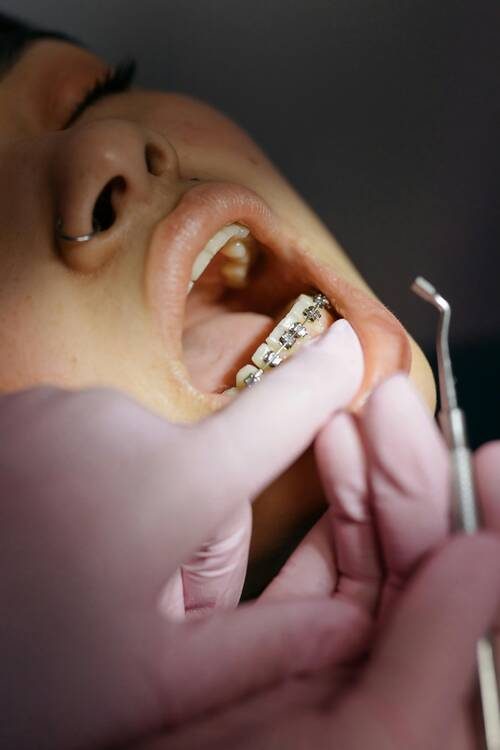 Metal braces treatment at REAL PEARL DENTAL CARE, Thaltej, Ahmedabad